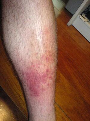 Click to see how Cellulitis can spead