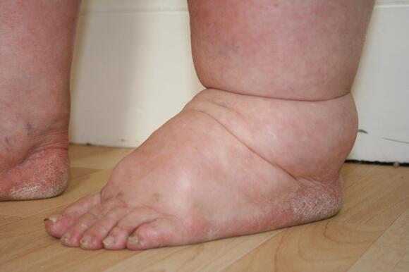 Redness gone click to see how foot and ankle are much smaller
